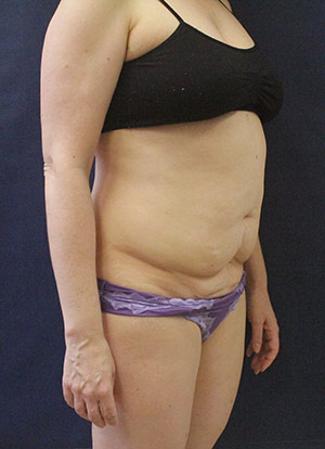Tummy Tuck Before and After Results