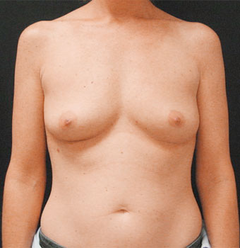 Breast Augmentation