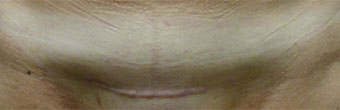 Scar Revision Case 2840 Before Photo Scar Revision