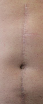 Scar Revision