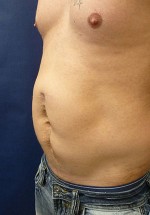 Abdominal Contouring