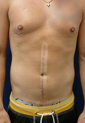 Abdominal Contouring