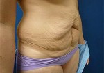 Abdominal Contouring