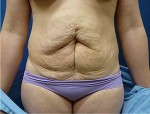 Abdominal Contouring