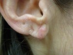 Earlobe Revision