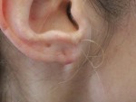 Earlobe Revision