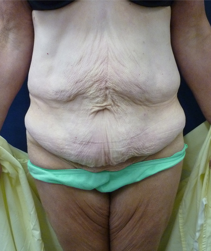 Abdominal Contouring