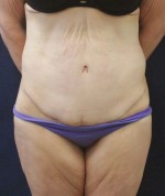 Abdominal Contouring