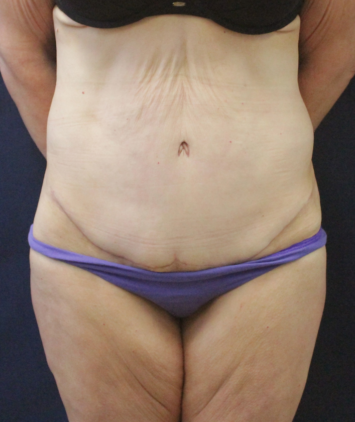 Abdominal Contouring