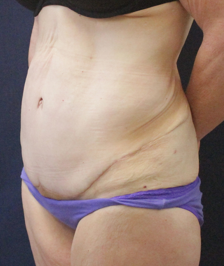 Abdominal Contouring