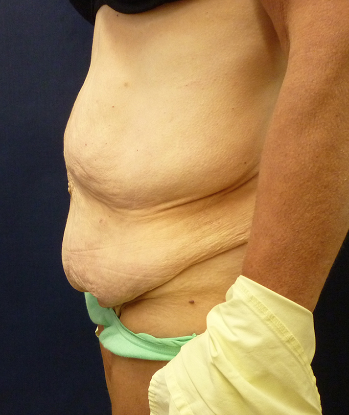 Abdominal Contouring