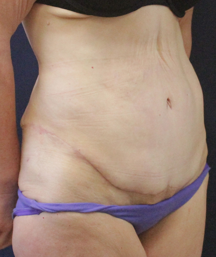 Abdominal Contouring