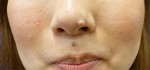 Facial Mole Removal