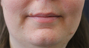 Facial Mole Removal
