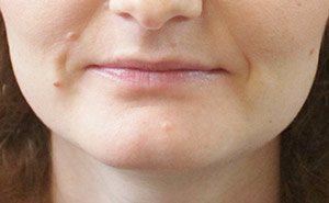 Facial Mole Removal