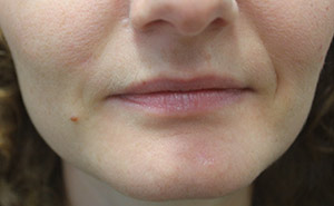 Facial Mole Removal