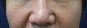 Facial Mole Removal