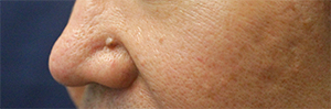 Facial Mole Removal