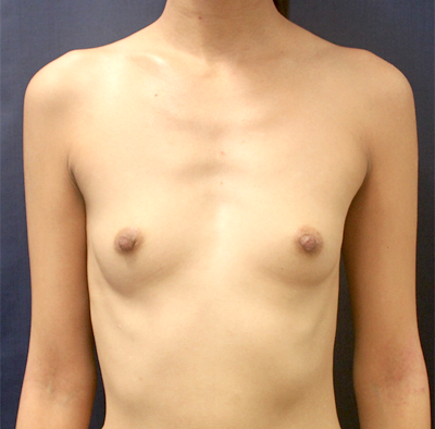 Breast Augmentation