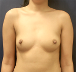 Breast Augmentation