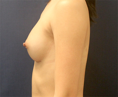 Breast Augmentation