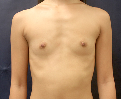 Breast Augmentation