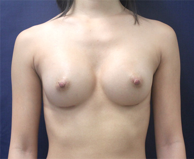 Breast Augmentation