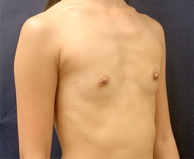 Breast Augmentation