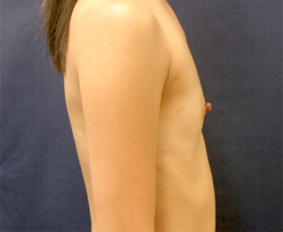 Breast Augmentation