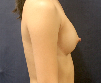 Breast Augmentation