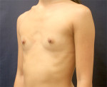 Breast Augmentation