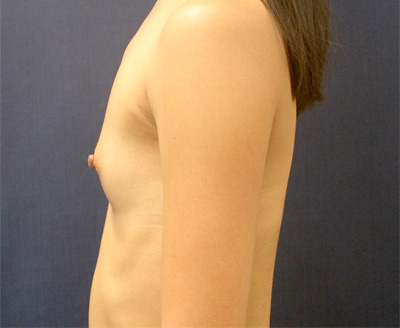 Breast Augmentation