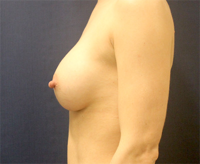 Breast Augmentation