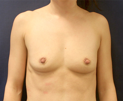 Breast Augmentation