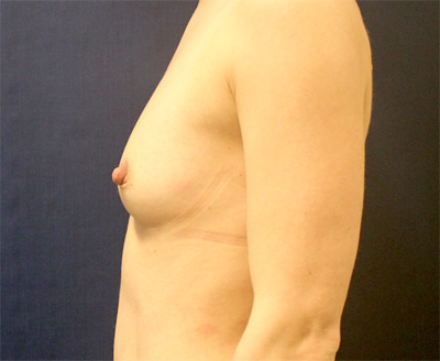 Breast Augmentation