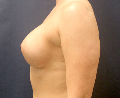 Breast Augmentation