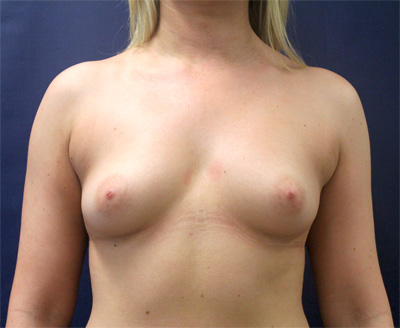 Breast Augmentation