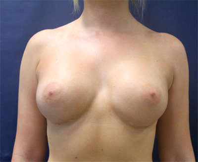 Breast Augmentation