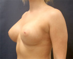 Breast Augmentation