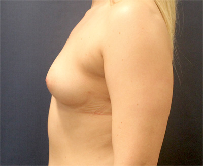 Breast Augmentation