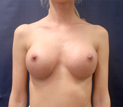 Breast Augmentation