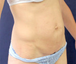 Abdominal Contouring