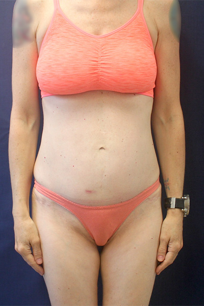 Abdominal Contouring