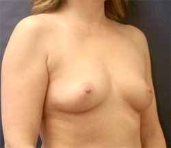 Breast Augmentation