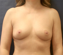 Breast Augmentation