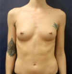 Breast Augmentation