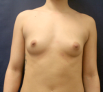 Breast Augmentation