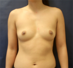 Breast Augmentation