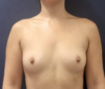 Breast Augmentation