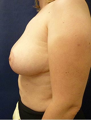 Breast Reduction